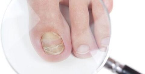 Diagnosis of fungus