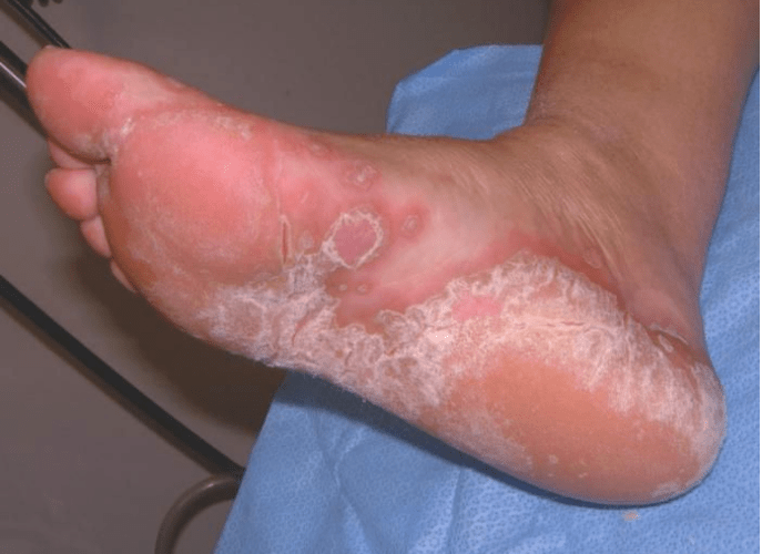 Determine the fungus of the foot