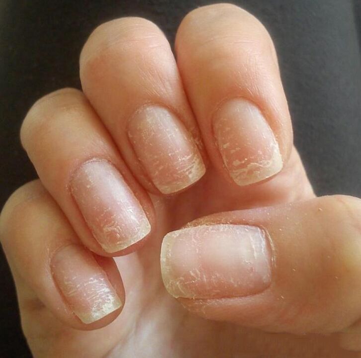 Treatment and prevention of fungus