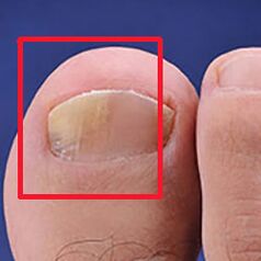 Mycosis or nail fungus