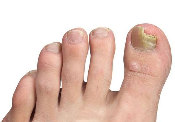 How is infection with a fungus