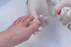 fungal toenail treatment