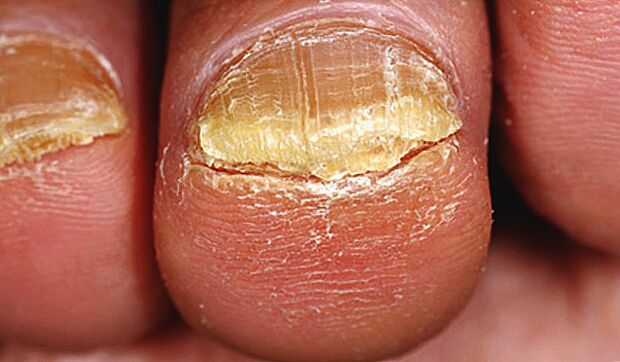 advanced fungus on toenails