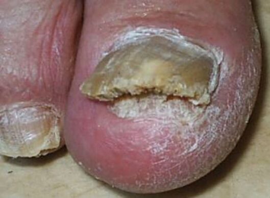 photo of toenail fungus