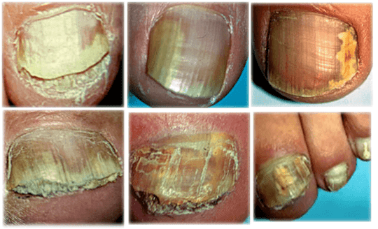 types and forms of fungus on the toenails