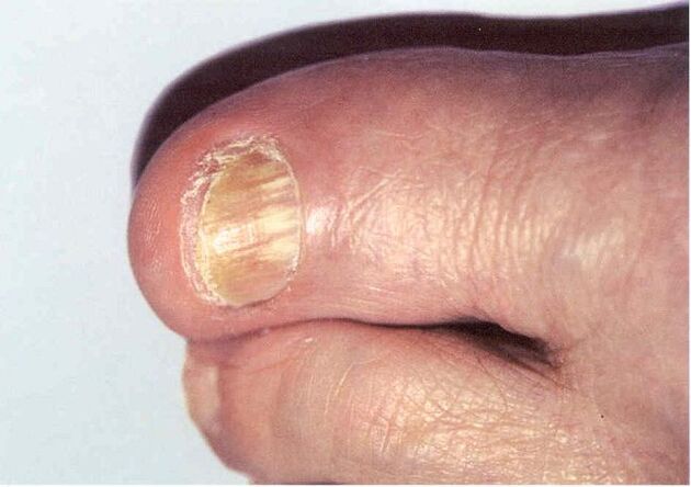 Onychomycosis - infection of the toenails by fungi