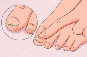 nail fungal infection