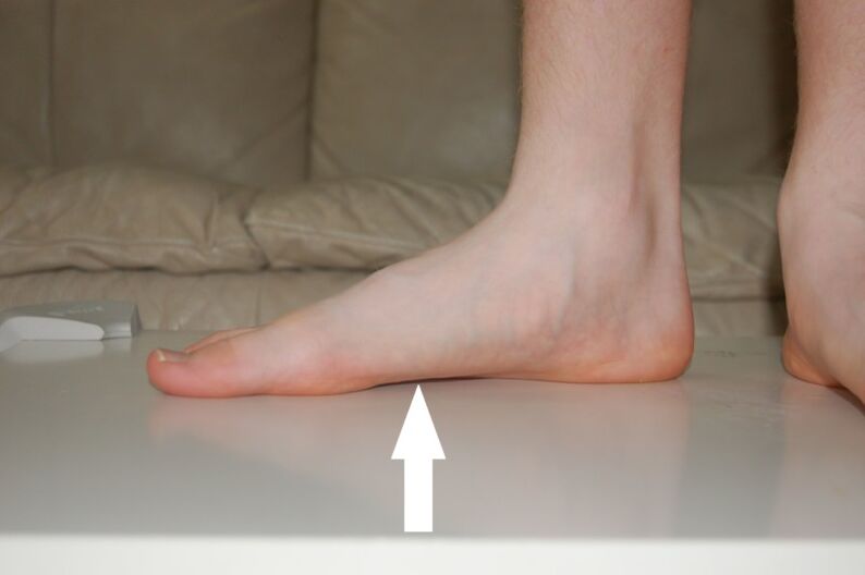 flat feet cause