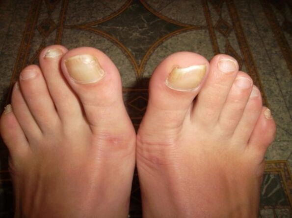 Fungal infection of big toe nails