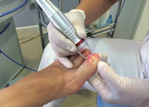 Laser treatment for nail fungus on the big toe